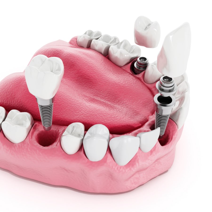 Implantologia | Studio Dentistico Buganè