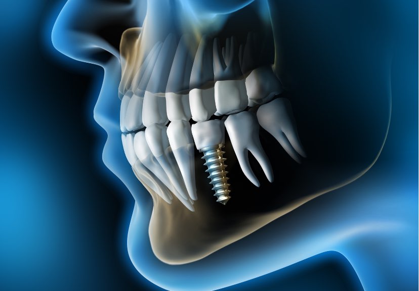 Implantologia | Studio dentistico Buganè